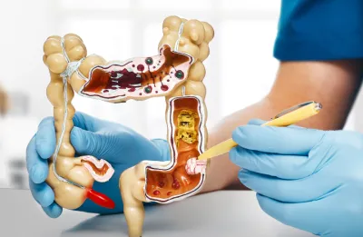 A model of a human colon displaying various stages of polyp.